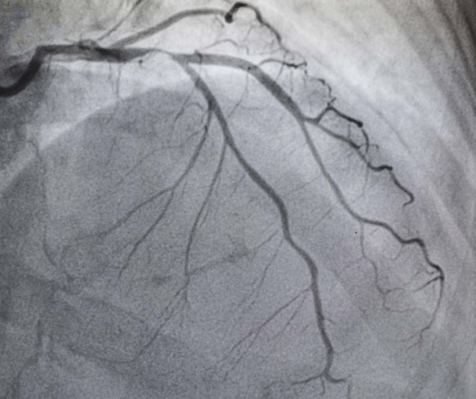 What is the cost of Angiography in Mumbai?